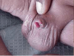 circ penile amputation