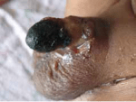 circ penile necrosis2